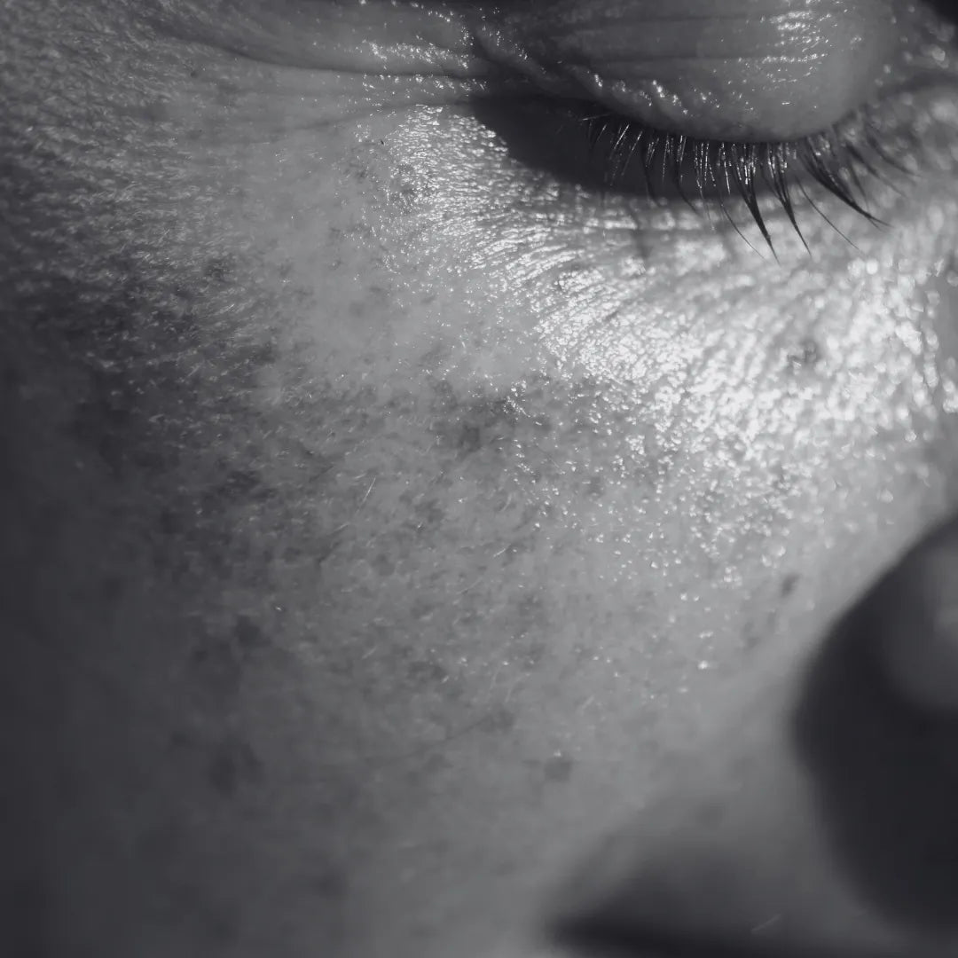 Pigmentation - KOA Luxury