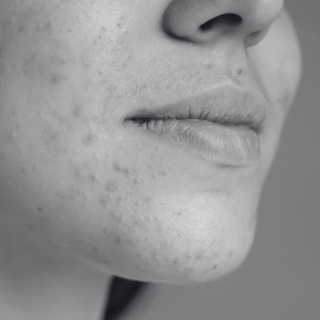 Acne & Breakout