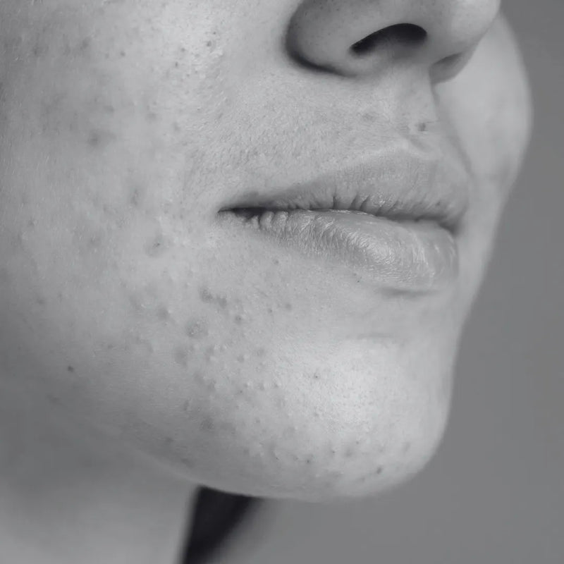 Acne & Breakout