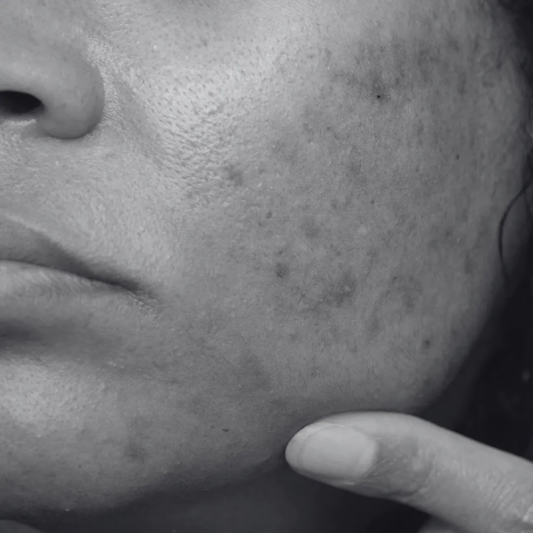 Uneven Skin Tone