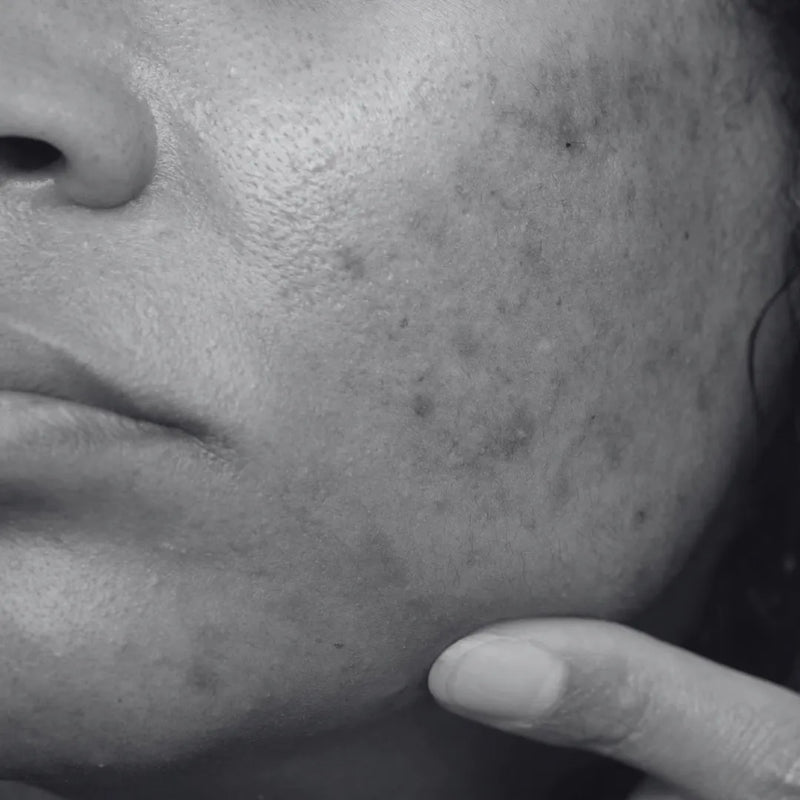Uneven Skin Tone